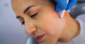 Non-Surgical Lifting: How Cheek Filler for Facial Contouring Creates a Defined Jawline